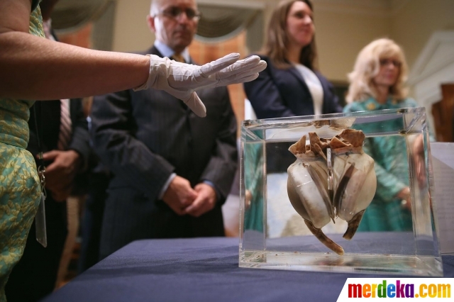 Foto Ini jantung buatan  pertama yang berhasil selamatkan 
