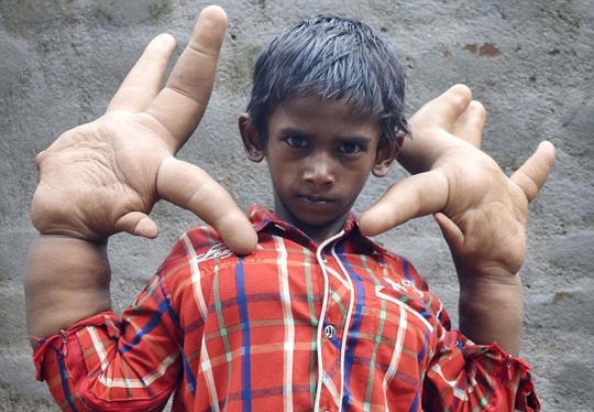 Bocah ini miliki tangan terbesar di dunia
