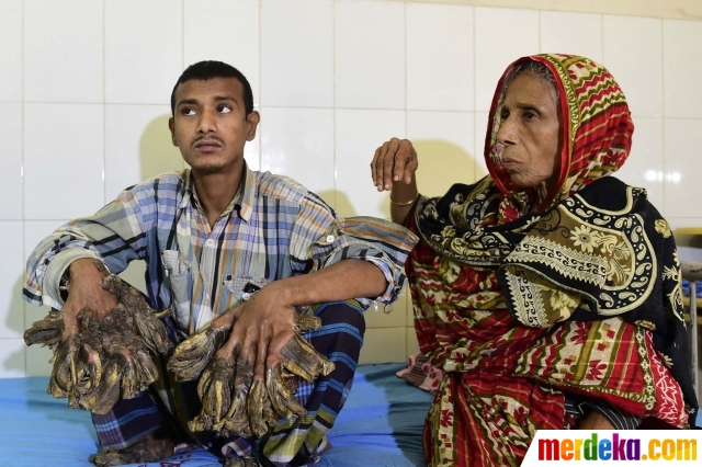 Manusia Pohon Foto Abul Bajandar si Manusia Pohon asal Bangladesh 