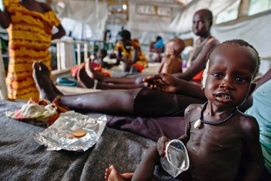 Potret memilukan bocah penderita gizi buruk di Sudan Selatan