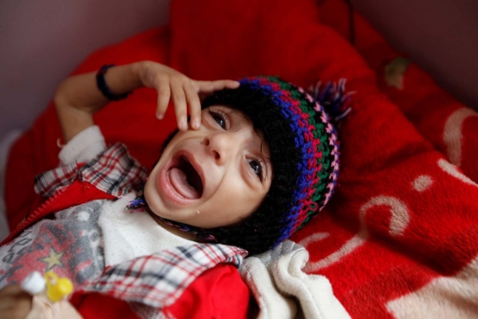 Potret ironis anak-anak korban busung lapar akibat perang Yaman