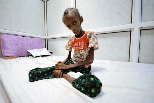 Potret prihatin bocah Yaman kekurangan gizi gara-gara konflik