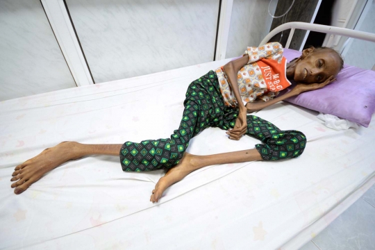 Potret prihatin bocah Yaman kekurangan gizi gara-gara konflik