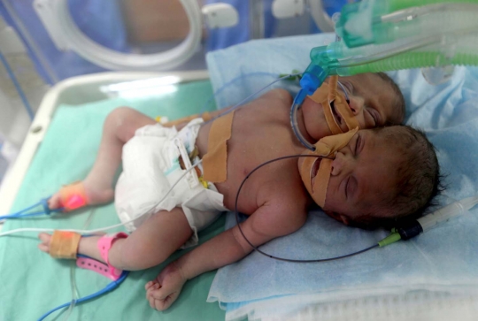Ini kondisi bayi berkepala dua yang lahir di Jalur Gaza