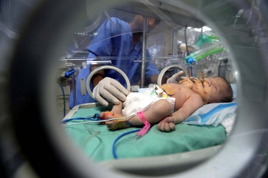 Ini kondisi bayi berkepala dua yang lahir di Jalur Gaza