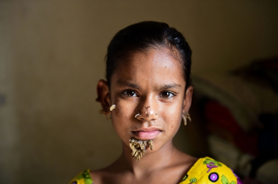 Meratapi gadis Bangladesh derita sindrom manusia pohon