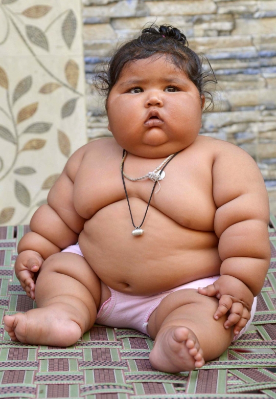 Kisah Chahat, bayi 8 bulan dengan berat 17 kg
