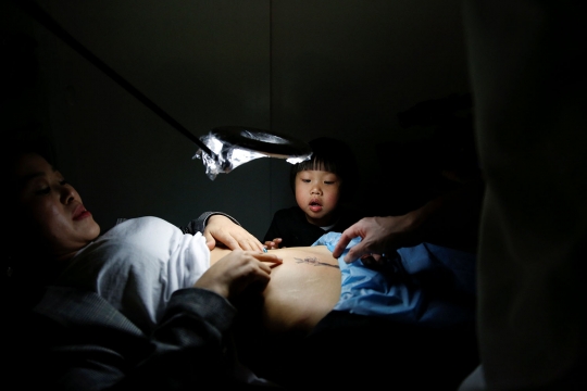 Ini cara unik ibu-ibu di China tutupi bekas operasi caesar