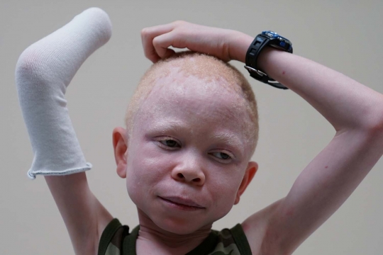 Meratapi bocah Albino tangannya dipotong & dijadikan jimat