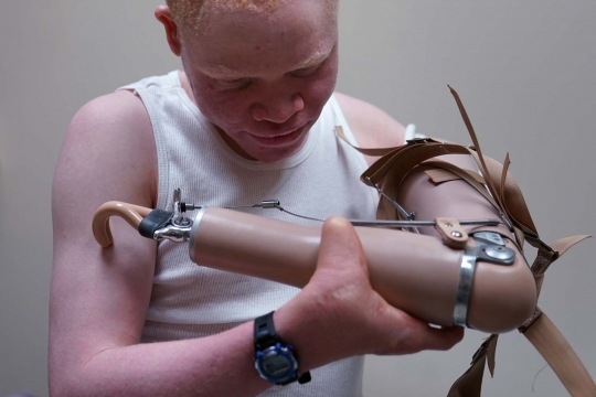 Meratapi bocah Albino tangannya dipotong & dijadikan jimat