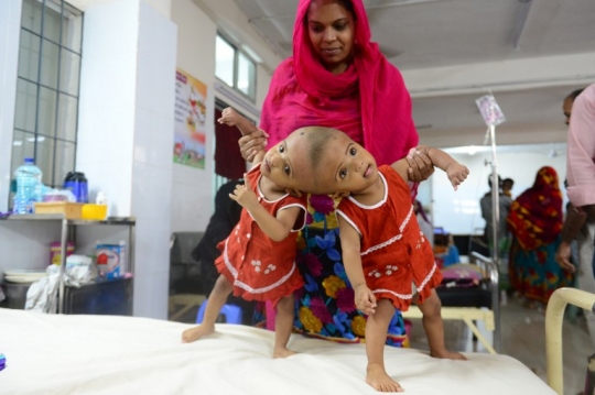 Potret pilu bayi kembar di Bangladesh berkepala dempet