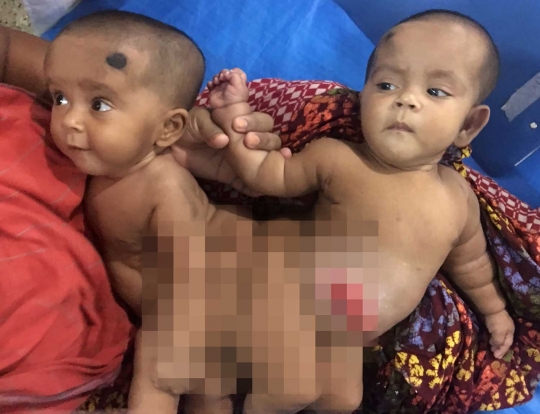 24 Dokter ahli bedah Bangladesh berhasil pisahkan bayi kembar siam