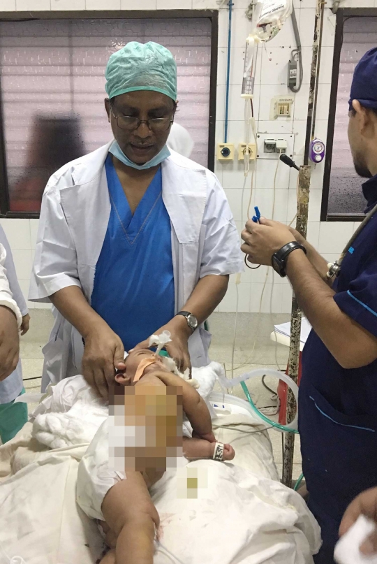 24 Dokter ahli bedah Bangladesh berhasil pisahkan bayi kembar siam