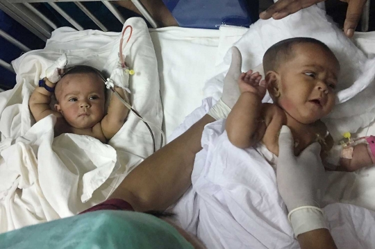24 Dokter ahli bedah Bangladesh berhasil pisahkan bayi kembar siam