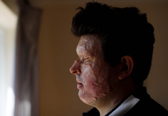 Nestapa Andreas, wajah rusak karena serangan air keras salah sasaran