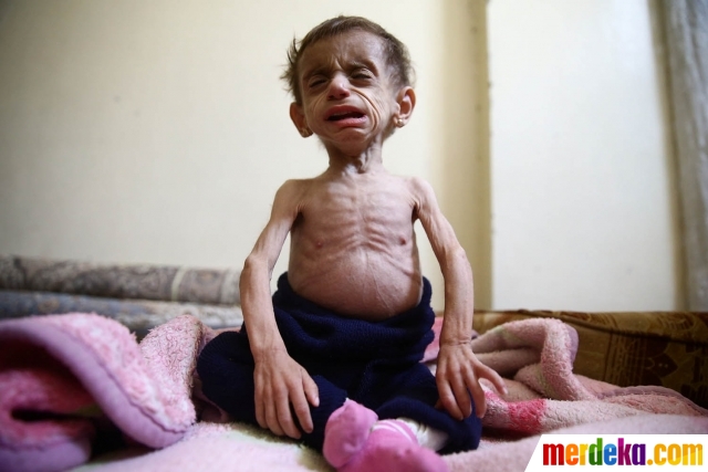  Foto  Meratapi nasib pilu anak  anak  Suriah menderita gizi  