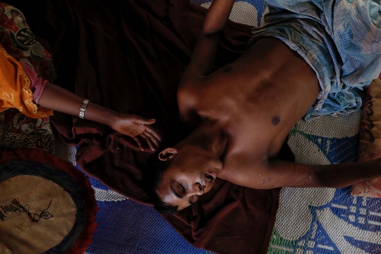 Tragis, pria Rohingya kehilangan kaki dan penglihatan akibat ranjau Myanmar
