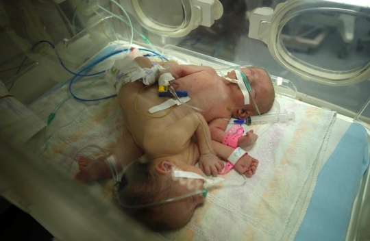 Potret haru bayi kembar siam asal Gaza berhasil dipisahkan
