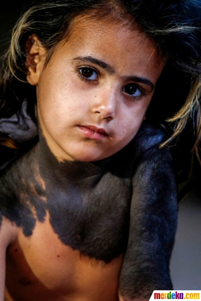 Foto Derita bocah miskin Irak idap penyakit kulit langka 