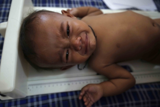 Anak-anak di Pandeglang terindikasi malnutrisi