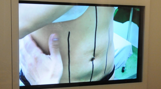 Mengenal Operasi Plastik Liposuction oleh Dokter Avraham Levy di RS EMC Sentul