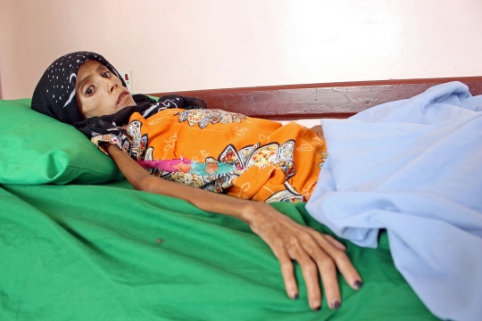 Meratapi Gadis Korban Perang di Yaman Derita Gizi Buruk