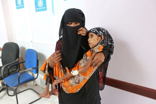 Meratapi Gadis Korban Perang di Yaman Derita Gizi Buruk