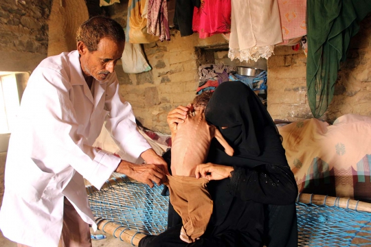 Meratapi Bayi Malnutrisi di Yaman Tubuhnya Tinggal Tulang dan Kulit