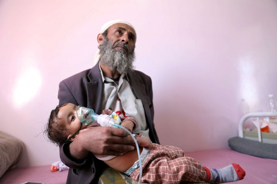 Potret Pilu Kasus Gizi Buruk di Yaman Capai Rekor Tertinggi
