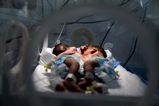 Kisah Bayi Kembar Siam di Yaman Berbagi Hati, Jantung, dan Paru-Paru