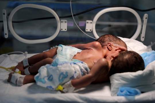Kisah Bayi Kembar Siam di Yaman Berbagi Hati, Jantung, dan Paru-Paru