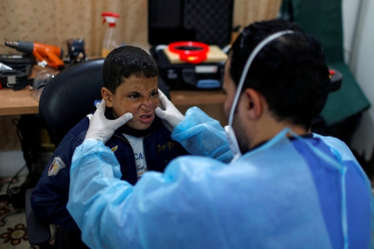 Alami Luka Bakar, Bocah Palestina Dibuatkan 'Wajah Transparan'