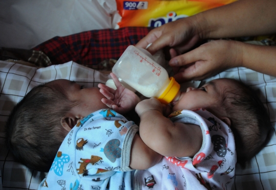 Bayi Kembar Siam di Sukabumi Ini Butuh Bantuan untuk Operasi Pemisahan