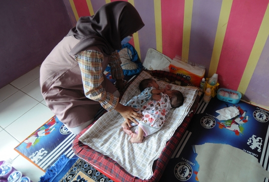 Bayi Kembar Siam di Sukabumi Ini Butuh Bantuan untuk Operasi Pemisahan