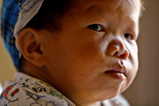 Remaja di Nepal dengan Tubuh Sebesar Bayi 1 Tahun
