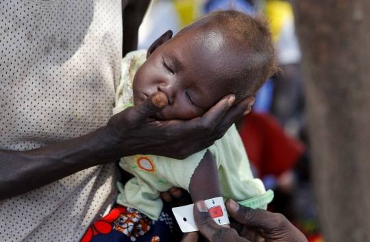 Potret Anak-Anak Somalia Menderita Gizi Buruk Akut