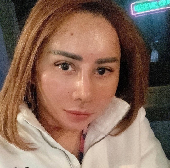 Foto Terbaru Femmy Permatasari Usai Jalani Oplas di Korea Selatan, Beda Banget