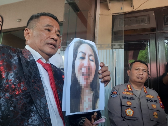 Foto-Foto Kondisi Venna Melinda usai Hidung Berdarah Akibat KDRT