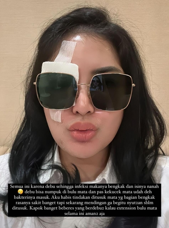 Mata Nindy Ayunda Alami Infeksi Hingga Bernanah, Ternyata Ini Penyebabnya