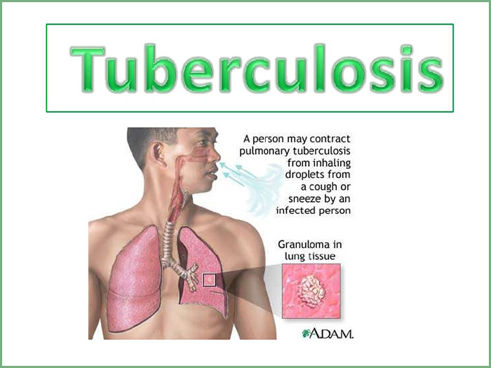 Image result for tuberculosis ADALAH