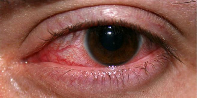 Mata Anda Berair? Sembuhkan Dengan Obat Alami Ini | FEED - MERDEKA.COM