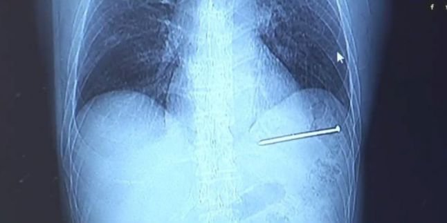 Tertembak Paku di Bagian Dada, Pria Ini Selamat 