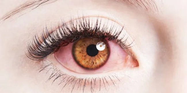 Cek Fakta Mata Merah Dan Berair Gejala Corona Covid 19 Benarkah Otosia Com