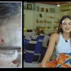 luna maya patah tulang, berita luna maya 