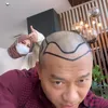 Anang Hermansyah tanam rambut di Turki