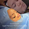 Potret Shafa Harris usai oplas hidung