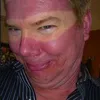 sunburn, bekas matahari, kelamaan berjemur, luka bakar kulit