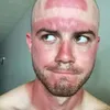 sunburn, bekas matahari, kelamaan berjemur, luka bakar kulit