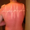 sunburn, bekas matahari, kelamaan berjemur, luka bakar kulit