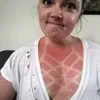 sunburn, bekas matahari, kelamaan berjemur, luka bakar kulit